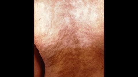 A Public Service Announcement: Syphilis