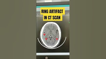 Ring artifact in ct scan #radiologycareer #viralshort #radiographer #ctscan#artifacts #medicalcourse