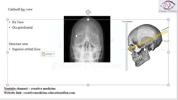Lec 1 X ray Views of Orbit   Caldwell luc view mp4 || OPHTHALMOLOGY