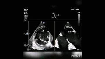 very clear transgastic view of the tricuspid valve