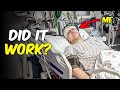 My Epilepsy Brain Surgery Update — Ended Live stream