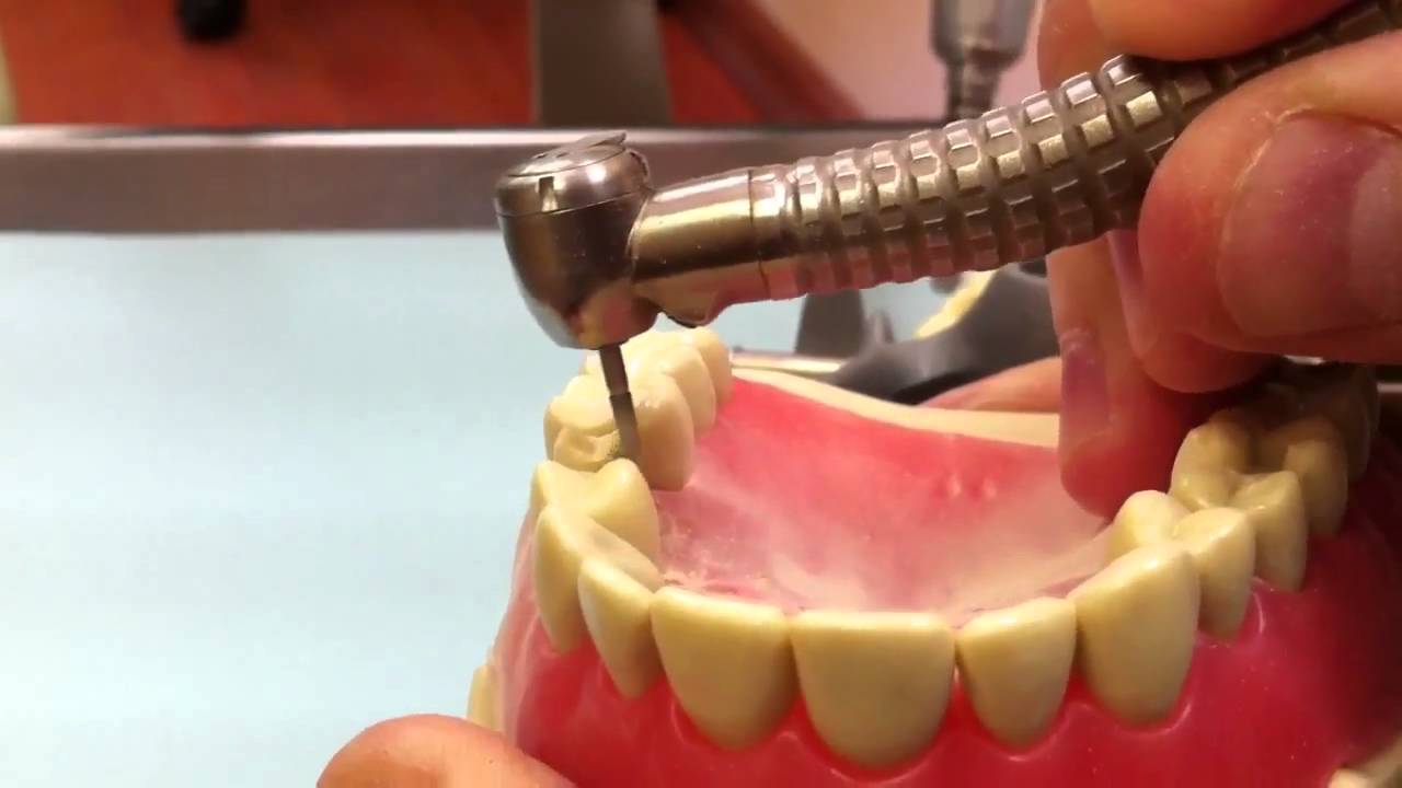 Crown prep, feather edge and shoulder for a CEREC crown YouTube