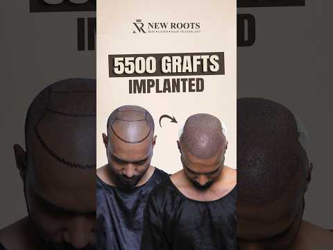 5500 Grafts Hair Transplant in Kolkata | Cost and Surgery #shorts