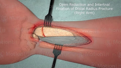 Right Arm ORIF Procedure of Distal Radius Fracture - 3D Medical Animation
