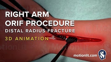 Right Arm ORIF Procedure of Distal Radius Fracture - 3D Medical Animation
