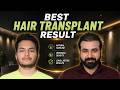Hair Transplant in Hyderabad (HX-RTHG) | Best Results & Cost of Hair Transplant in Hyderabad