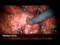 Robotic proctectomie with total mesorectal excision and colonic J pouch low rectalanastomosis 2D