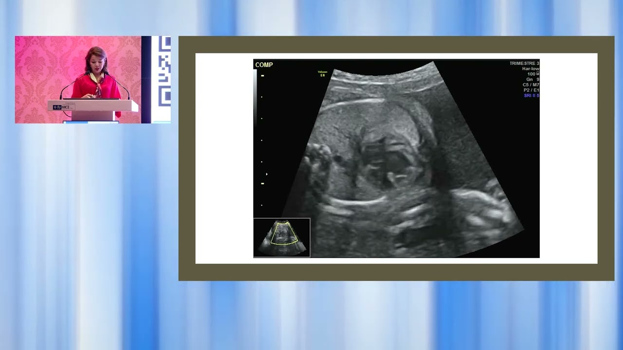 Les Journées d'échographie Septembre 2024 : Coupe des 4 cavités normale : Dr Gargouri Rania