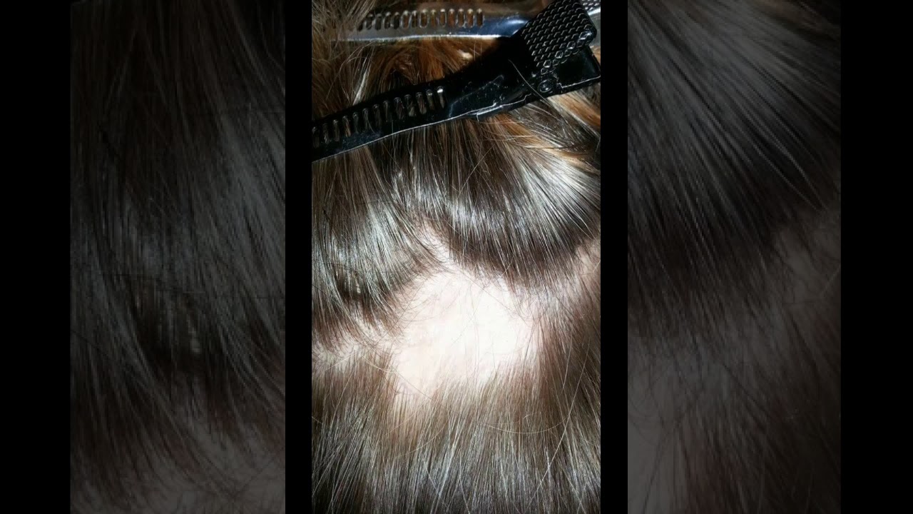 infoltimento. Patch cutaneo