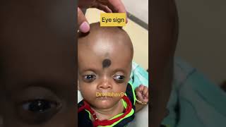 Hydrocephalus And Csf