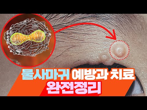 물사마귀 물렁종 전염성 연속종 전염되나 번지나? 치료는?