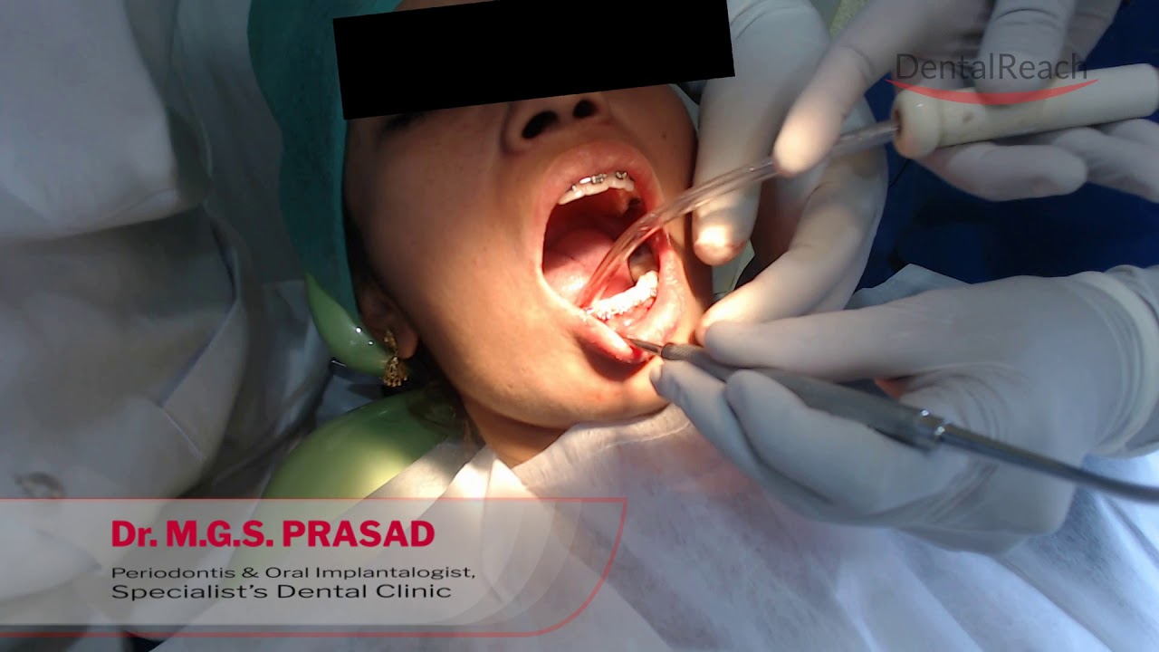 Dental Implant Procedure YouTube