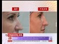 Як змінити форму носа без операції