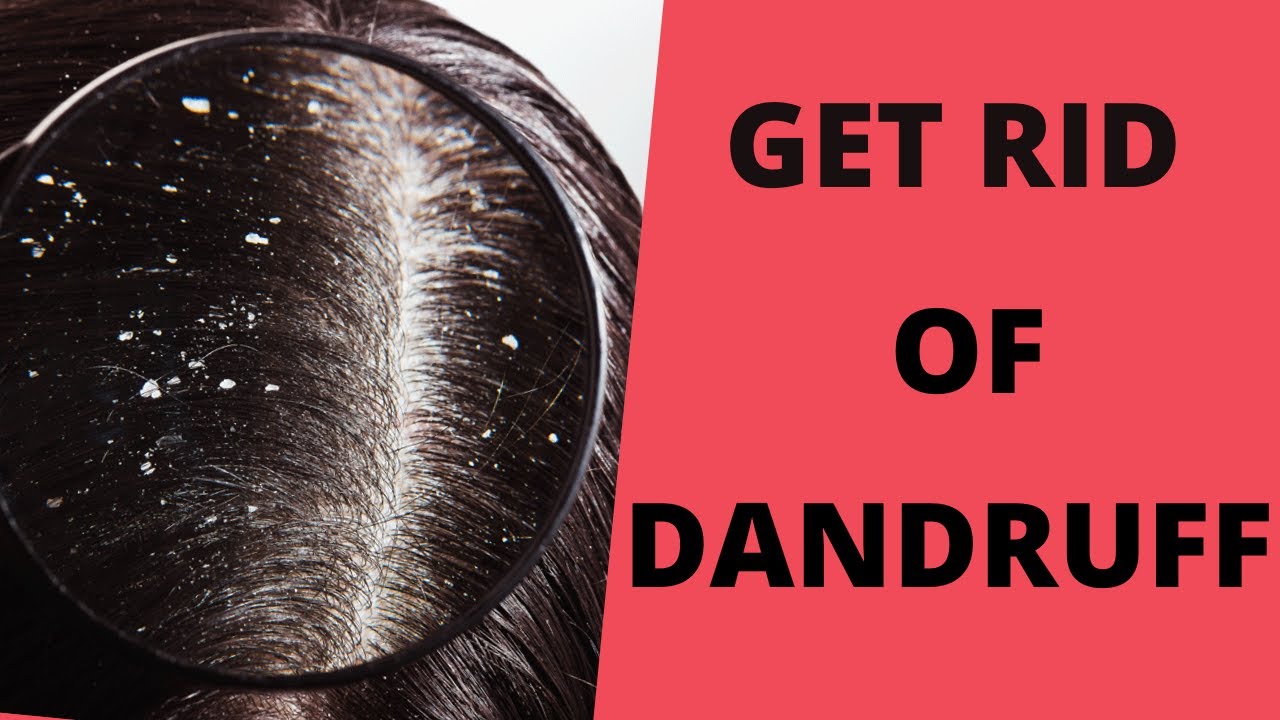 How to treat dandruff treatment at home by Beauty Secrets YouTube