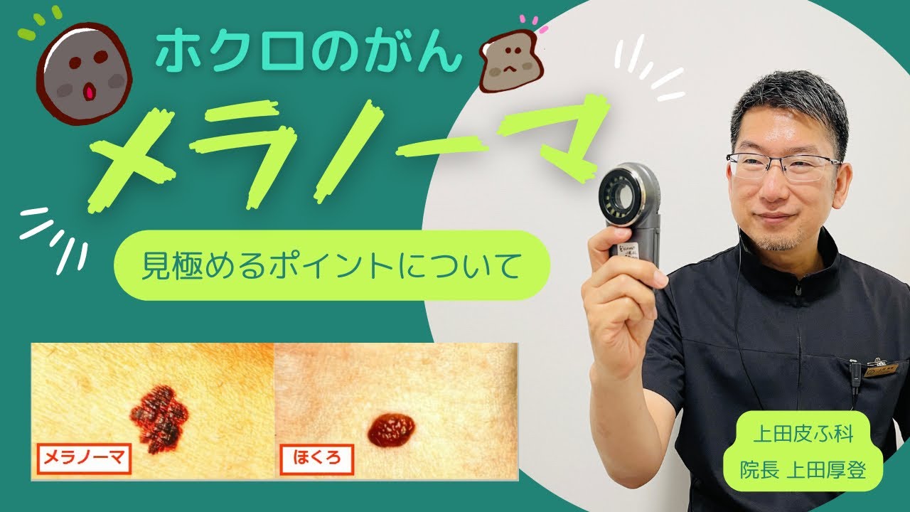 ホクロのがんメラノーマ 見極めるポイントについて 長崎県大村市の上田皮ふ科 上田皮ふ科 長崎県 皮膚科 皮膚がん Youtube
