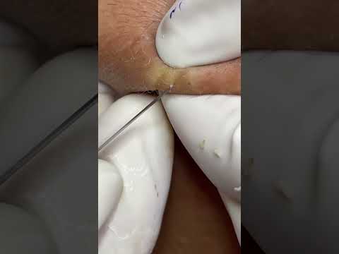 블랙헤드 Blackhead 표지 3