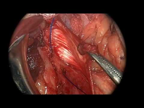 Operative Repair of Sports Hernia 