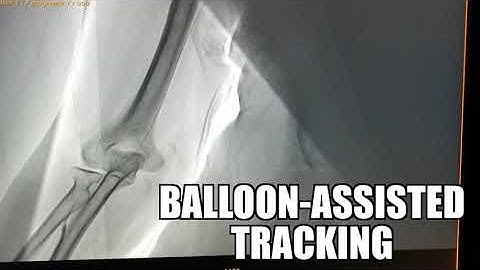 Balloon-assisted tracking