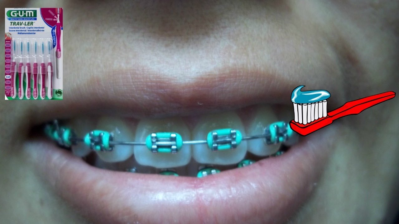 La Mejor Tecnica Para Lavarse Los Dientes Con Brackets Lora