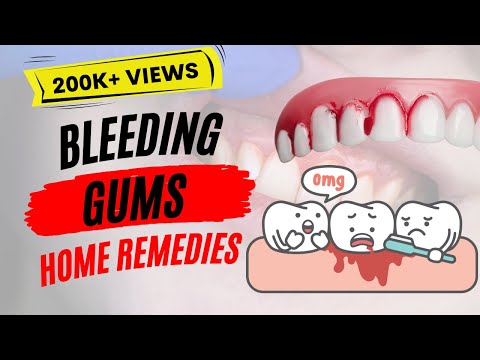 Video: Gums - Treatment Of Bleeding Gums With Folk Remedies