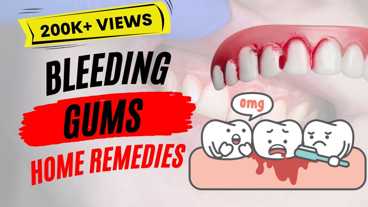 Bleedings Gums Causes And Best Home Remedies Youtube