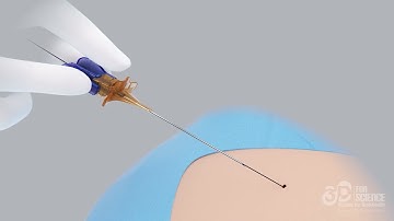 Catheter Introduction Without Scapel | 3D Animation Video | 3Dforscience