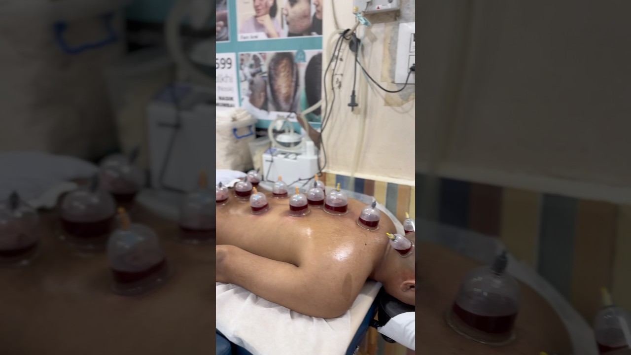 Is it okay to get Hijama therapy ? | what is hijama #hijama #manishjodhpuri