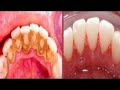 In just 2 Minutes - Turn Yellow Teeth to Pearl White, Teeth Whitening at Home ll NGWorld