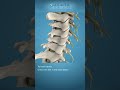 What is Cervical Disc Herniation? #Shorts