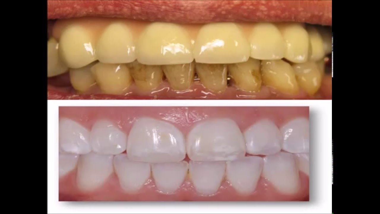 teeth yellow stains dental remove does take without brushing dentist plaque going deep someone would tooth whitening again using results