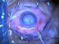 SICS Cataract Surgery - Intumescent Double Rhexxis and SimcoeFloatation