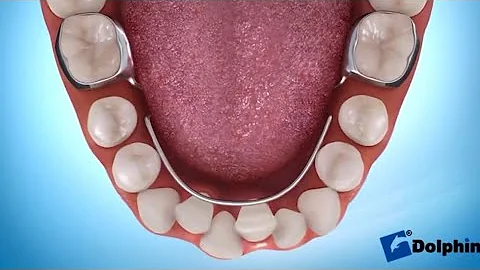 LLHA - Lower Lingual Holding Arch