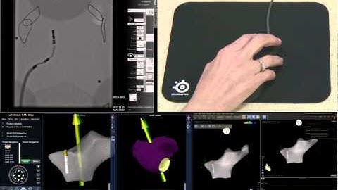 Stereotaxis Robotic Magnetic Navigation (RMN) Ablation Catheter Demo
