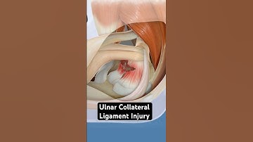 Ulnar Collateral Ligament Injury (3D animation)