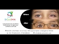 De cure center  ocular prosthetics  artificial eye  oncologists