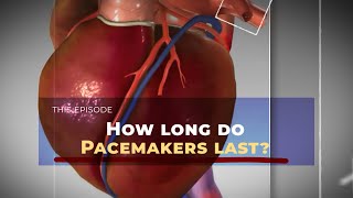 How long do Pacemakers last?