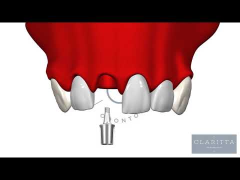 Como é um Implante Dental? Como é um procedimento de Reabilitação Oral através do Implante?