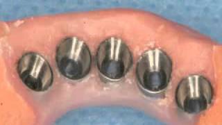 Teeth in 1-Day - part 4.mp4 by Gary R. O'Brien 4,033 views 12 years ago 3 minutes, 5 seconds