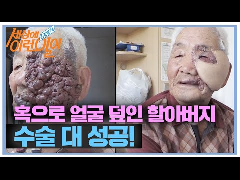 혹으로 얼굴이 덮인 할아버지, 성공적인 수술 후기!ㅣ순간포착 세상에 이런 일이(Instant Capture)ㅣSBS Story