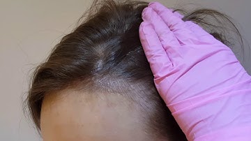 Receeding Female Hairline Microblading Micro-pigmentation by El Truchan @ Perfect Definition