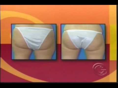 Goodbye Saddlebags: Liposuction by Dr. Jason Leedy...