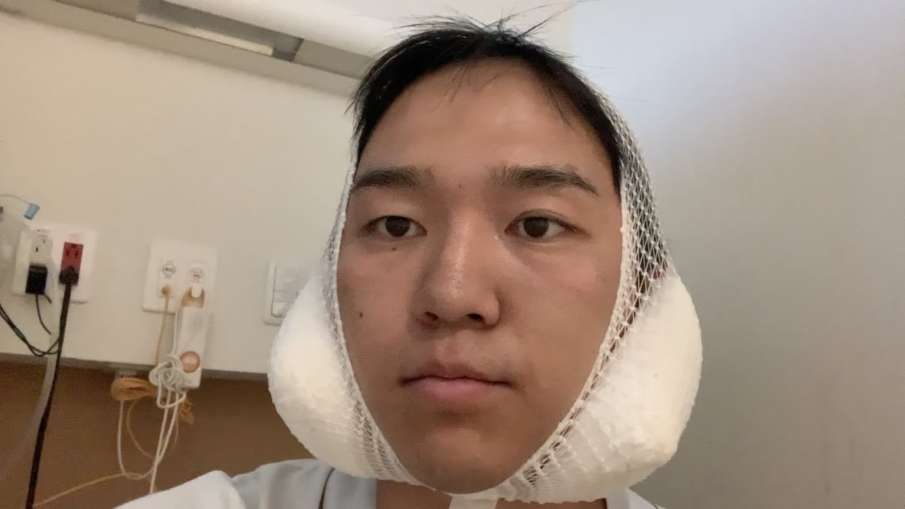 全身麻酔で親知らず抜いたけど辛すぎました【入院から術後１ヶ月】