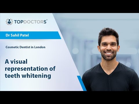 A visual representation of teeth whitening