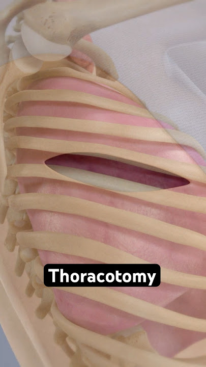 How surgeons get behind your ribs (3D Animation)