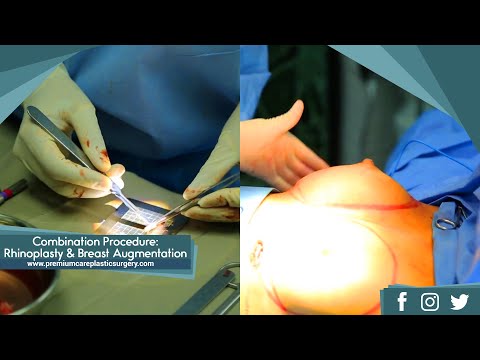 Video: Modellen Gjorde Bröstplastikkirurgi Hos Tandläkaren Och Visade Den 