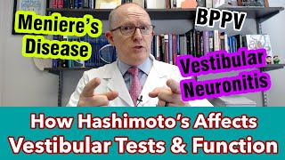 Chronic Vertigo? How Hashimoto’s Affects Vestibular Tests (caloric, OKN, VOR)