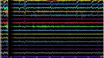 EEG monitoring