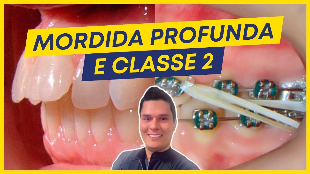 CLASSE 2 COM MORDIDA PROFUNDA - COMO TRATAR? - YouTube