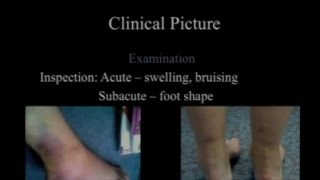 Acute Ankle sprains