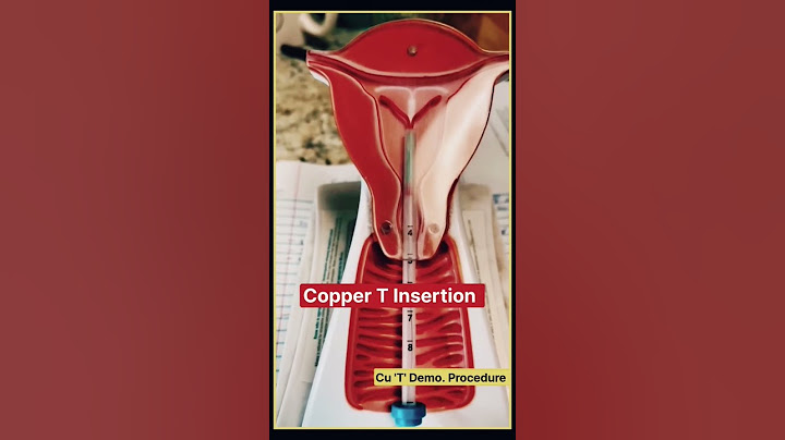 कॉपर टी कैसे डालते हैं ? Copper-t #IUCD #shorts #Neet #Medical #doctor #mbbs